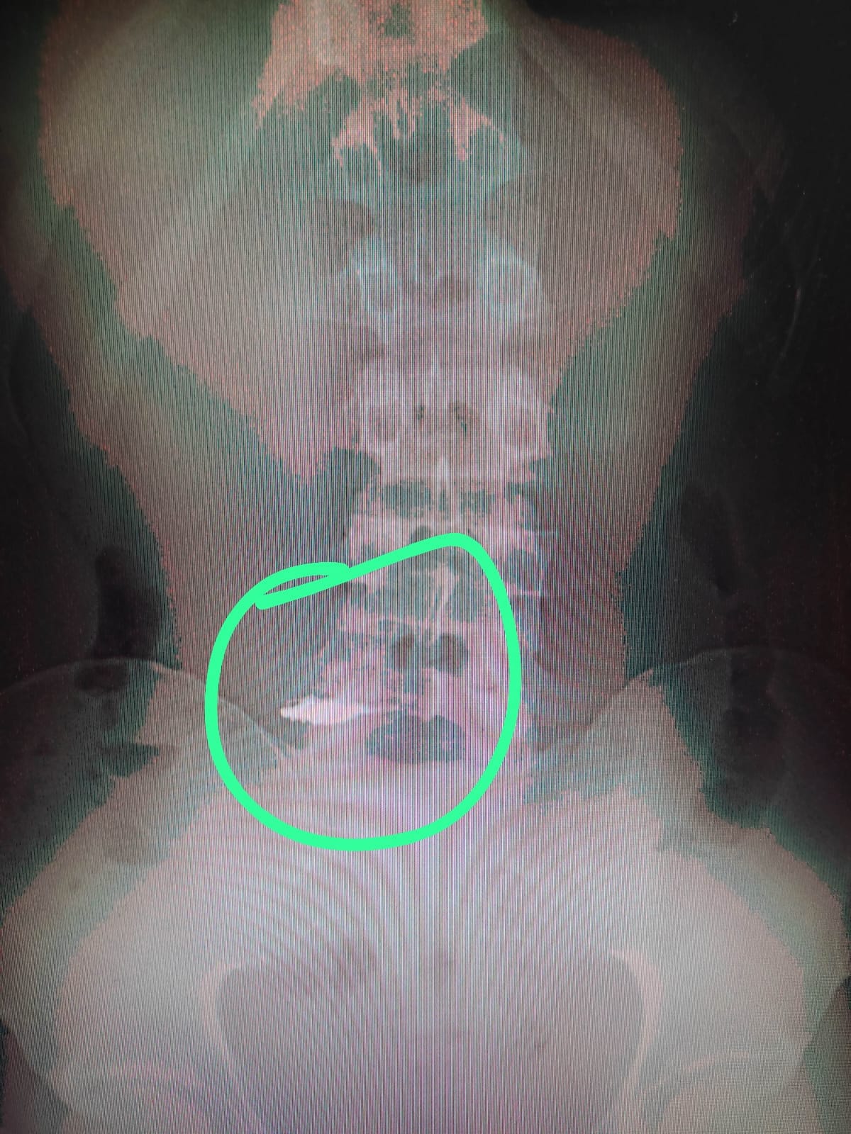 As correntes foram localizadas por meio de um raio-x. Foto: Reprodução