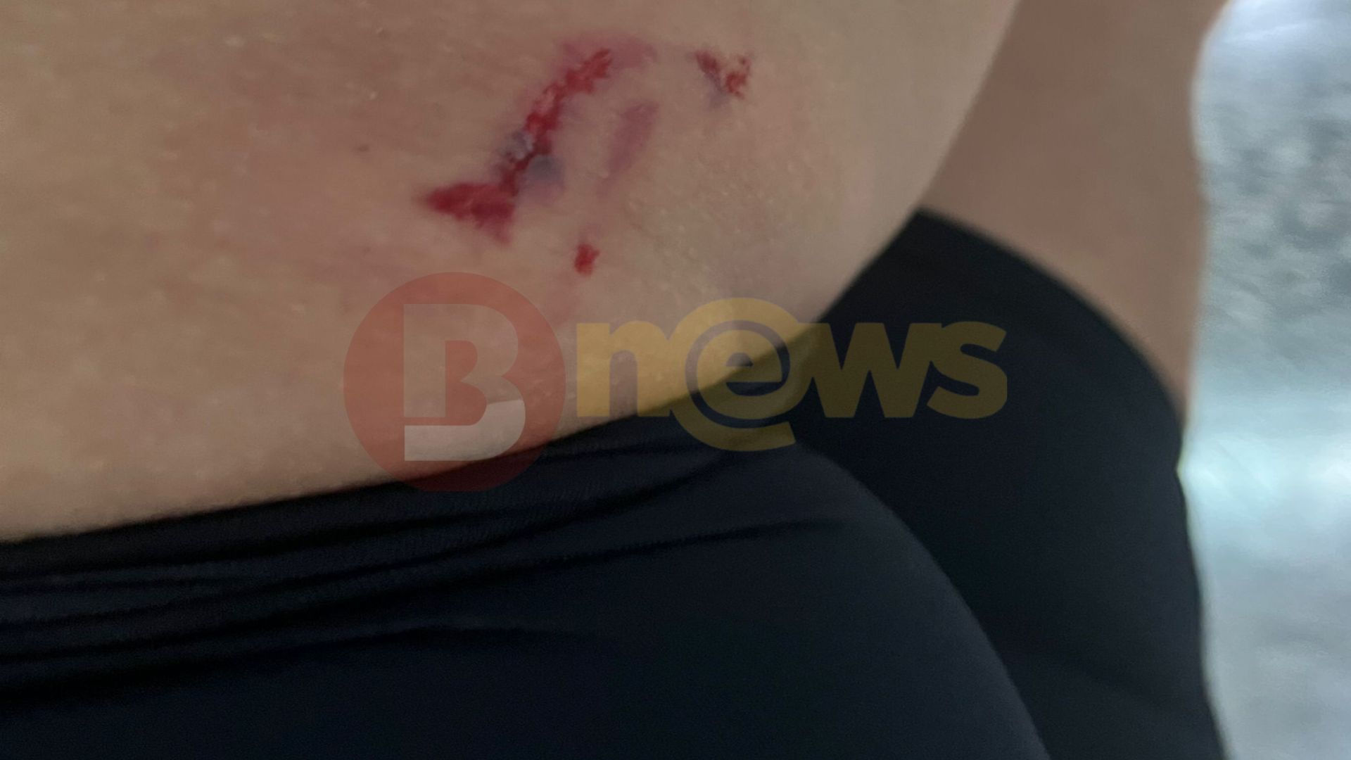 Vítima mordida por cão de rua na Vitória