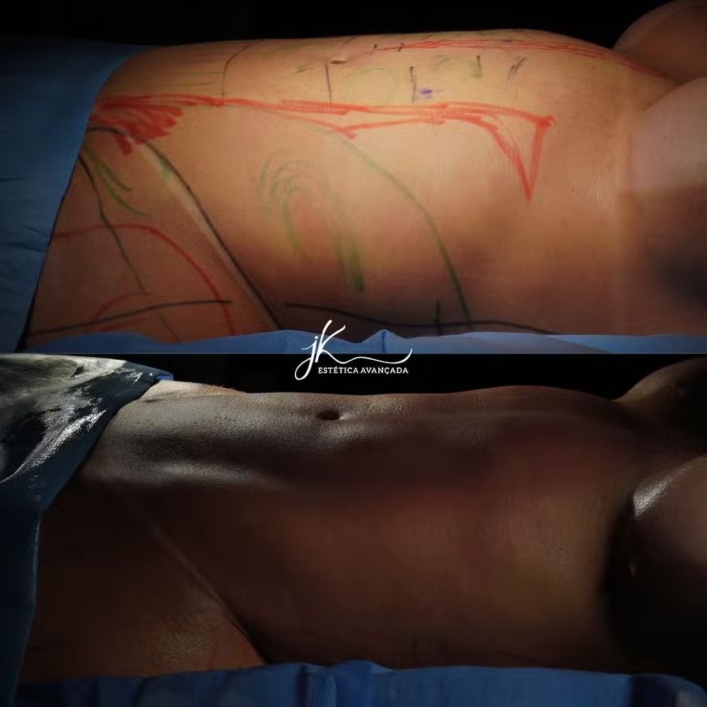 lipo