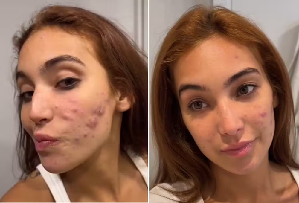 Ex-BBB Vanessa Lopes mostra evolução em tratamento da acne — Foto: Reprodução/Instagram