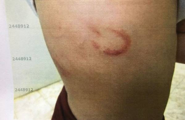 Criança, de 5 anos, foi agredida com corrente e acabou marcada na região das costas