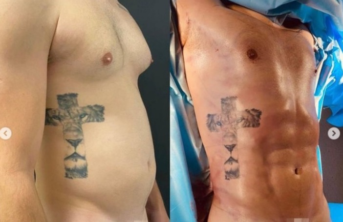 lipolad caio afiune