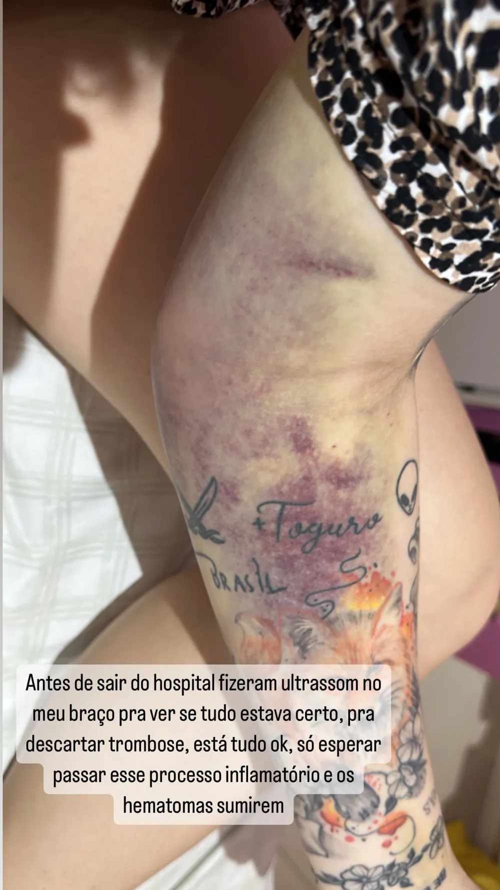 Hematomas 